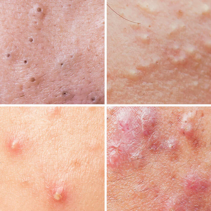Skin Disease